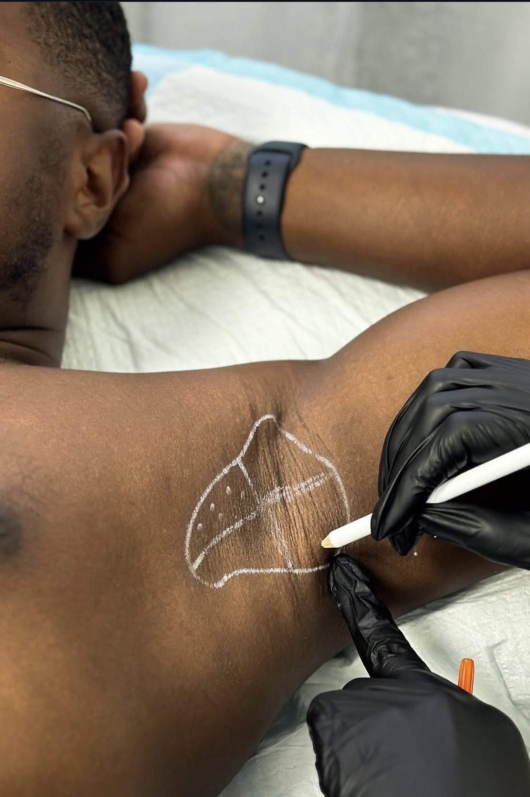 A practitioner mapping a treatment area on a patient's body at Brimstone Medical