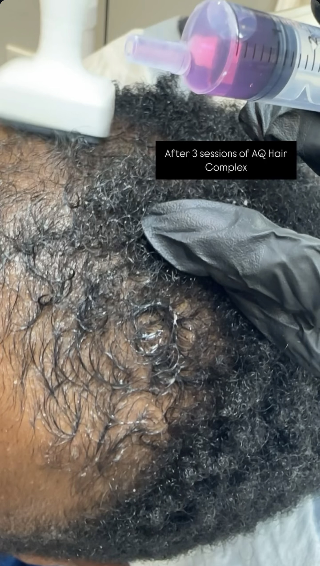 A scalp mesotherapy hair restoration treatment being performed at Brimstone Medical