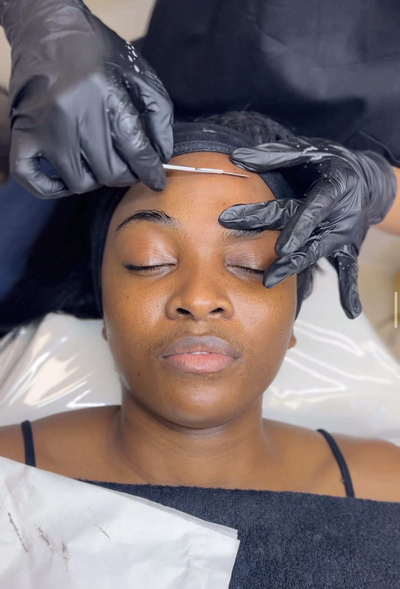 A mesotherapy treatment being carried out on a patient's face at Brimstone Medical