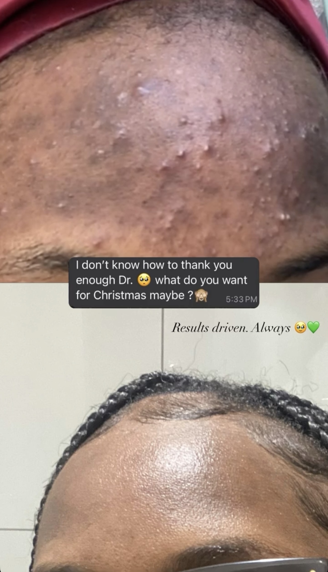 Before and after: Acne Programme