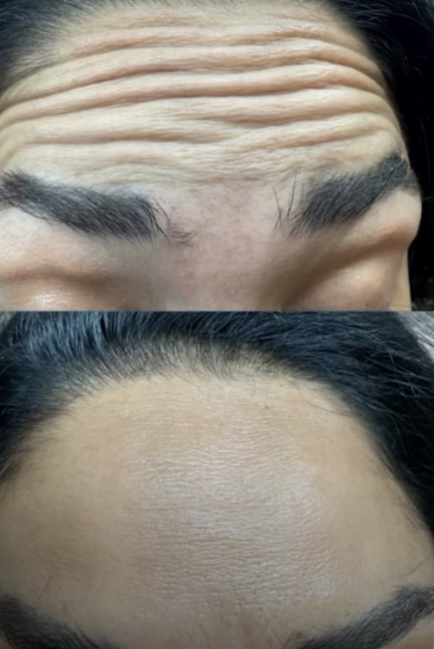 Before and after: Anti-Wrinkle Injections