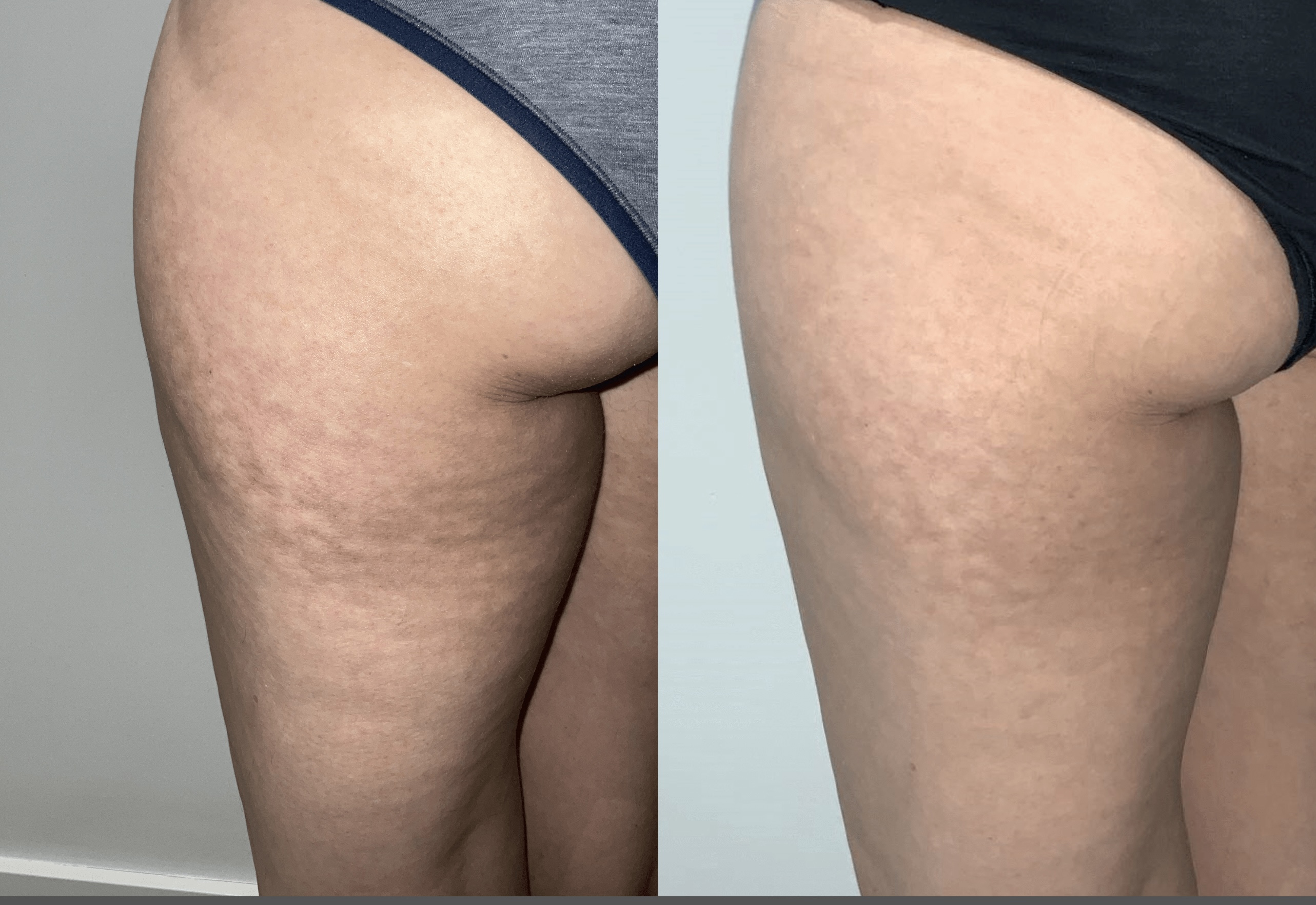 Before and after: Cellulite & Body Contouring