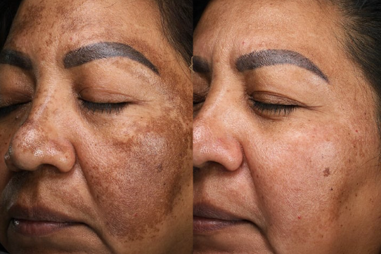Before and after: Melasma Treatment + Skin Mapping