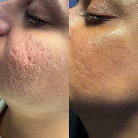 Before and after: RF Microneedling Course